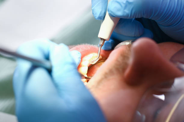 Best Emergency Dentist for Knocked-Out Tooth in Putney, GA